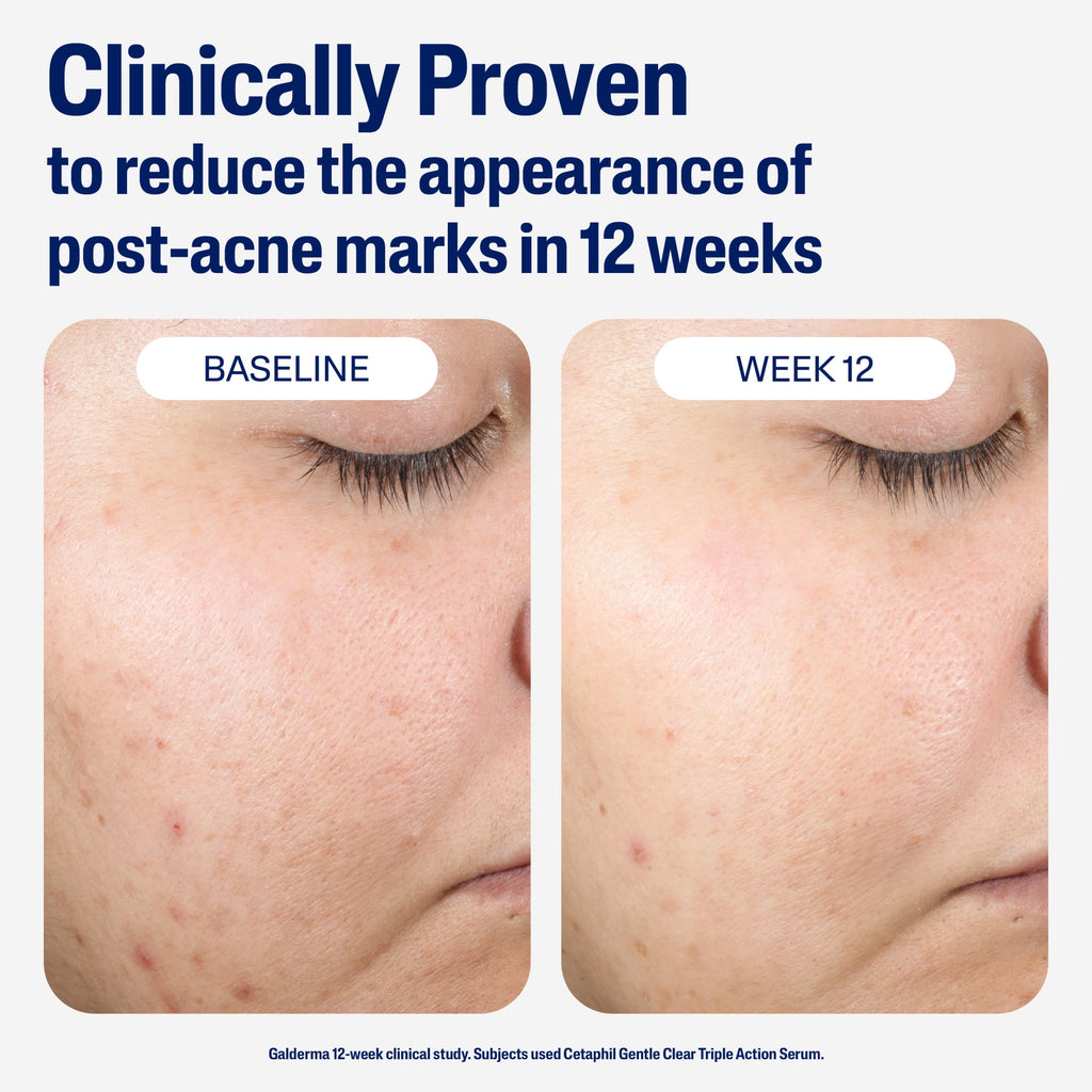 Cetaphil Gentle Clear Repairing Post-Acne Serum, Retinol Alternative, Oil Free Serum, Acne-Prone Skin, 1 fl oz